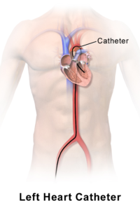 Heart catheterization from the groin or the wrist