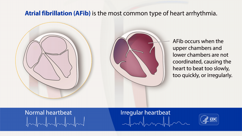 Atrial fibrillation Animation