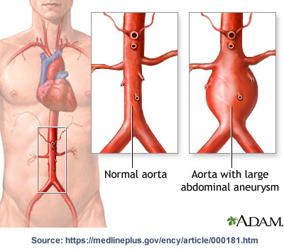 Angioplasty and stent placement - heart: MedlinePlus Medical