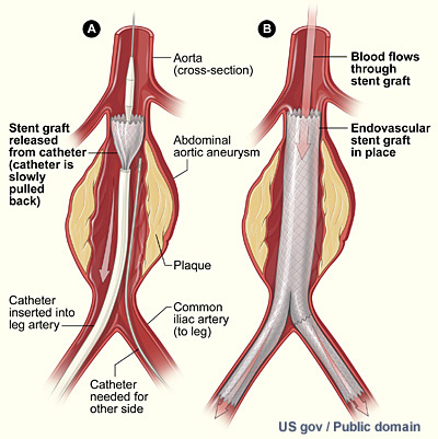 Aneurysm endovascular stent graft