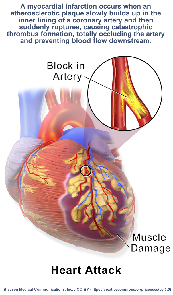 Heart Failure | Causes, Symptoms and Risk factors of Heart Failure