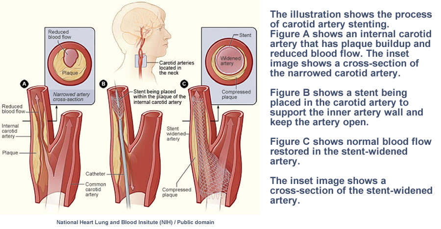 Coronary Artery Disease (CAD) stenting