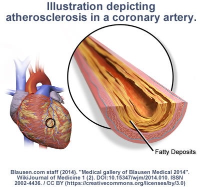 coronary artery plaque