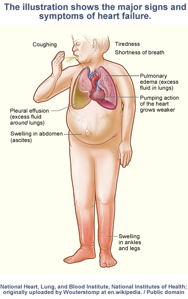 major signs and symptoms of heart failure