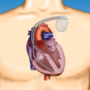 IMPLANTABLE DEFIBRILLATOR (ICD) SYSTEM