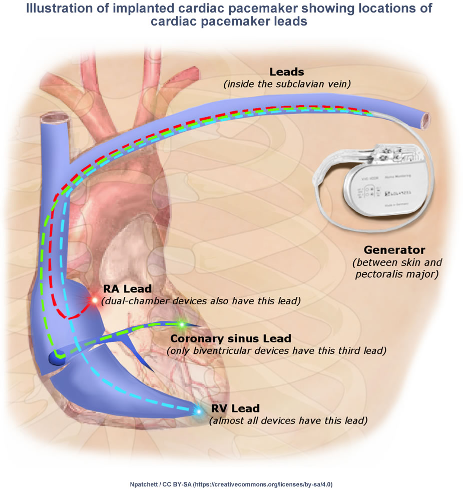 Illustration of Implanted Pacemaker