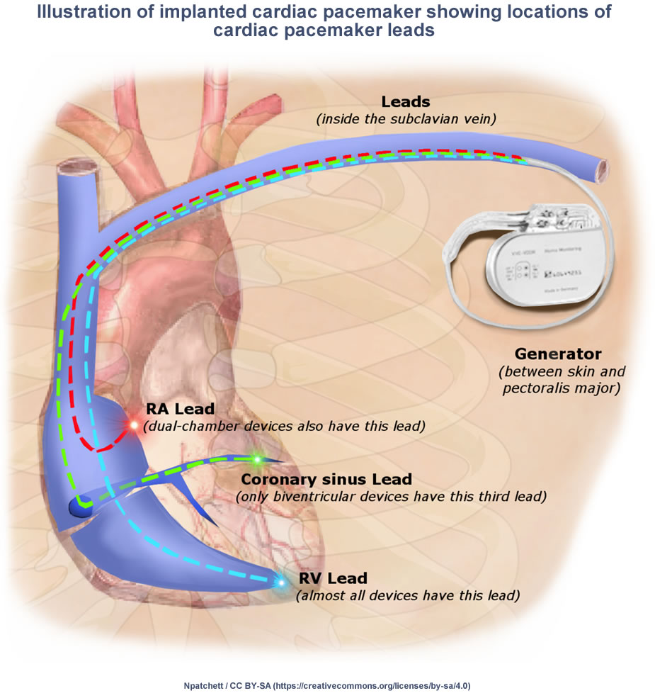 Types Of Pacemakers Used To Treat Bradycardia Or Slow Heart Rate 