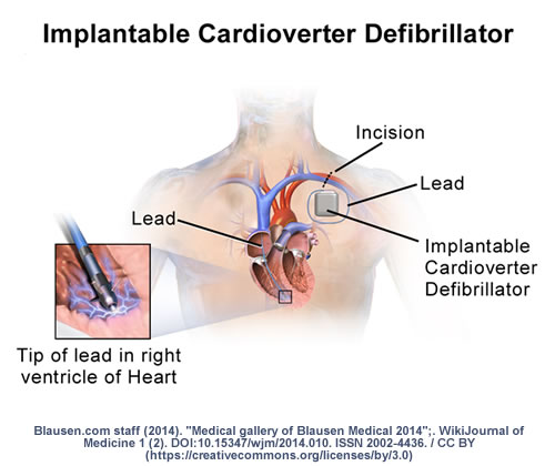 Implanted defibrillator on sale