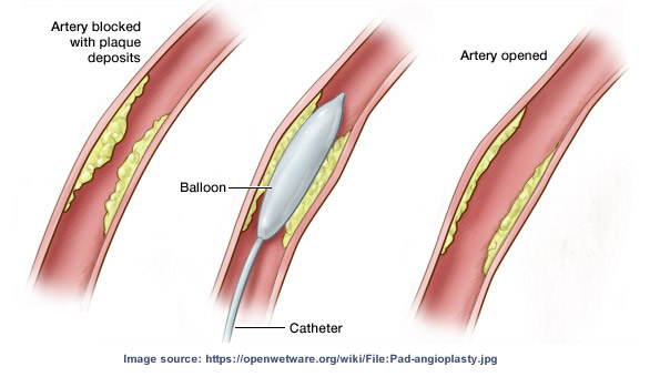 angioplasty ultra balloon