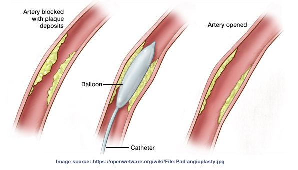 Drug-Coated Balloon Angioplasty