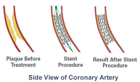 endovascular stent graft procedure illustration