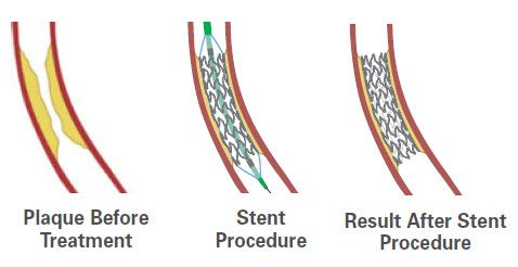 Stent Illustration - Before, During and After Stent Procedure