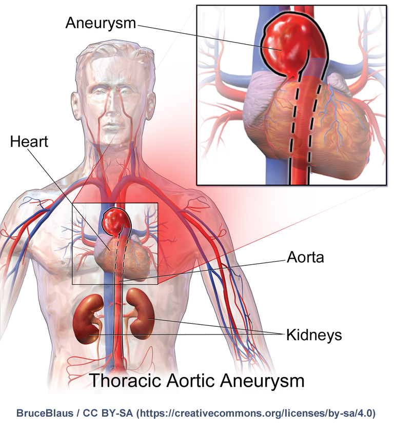 thoracic aortic aneurysm