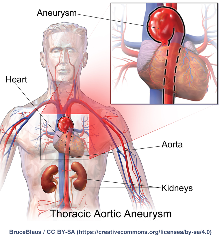 how is a thoracic aortic aneurysm diagnosed