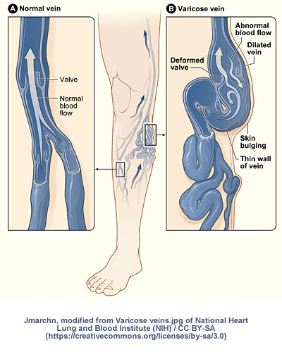 How are Varicose Veins formed?