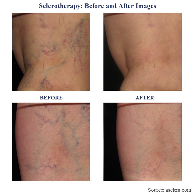 Before and after Sclerotherapy 