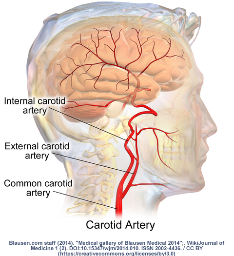 severed carotid artery in brain