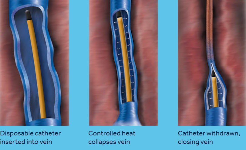 ClosureFast Procedure Overview