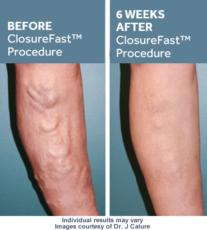 TREATMENT OF VEIN DISEASES 