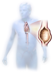 Thoracic Aortic Aneurysm (TAA)