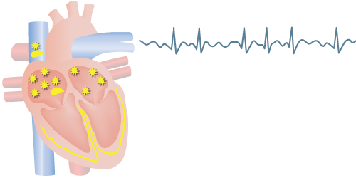 atrial fibrillation animation