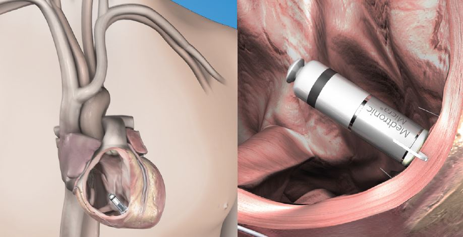 transcatheter pacing system implant