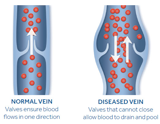 Vein Disease