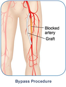 Bypass Procedure