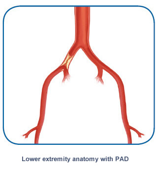 Lower extremity PAD