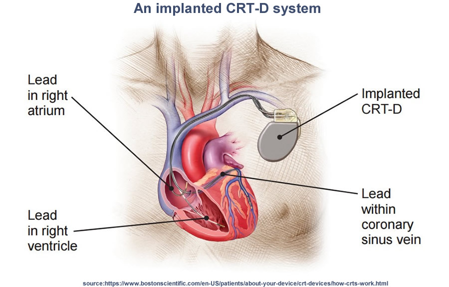 cardiac resynchronization therapy defibrillator (CRT-D)