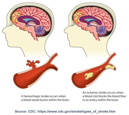 Types of Strokes