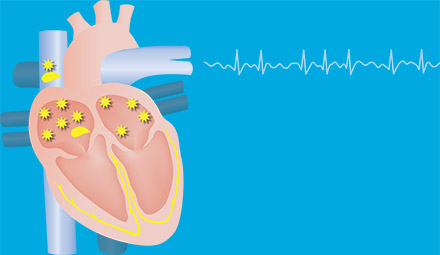 suspected AFB heart beat