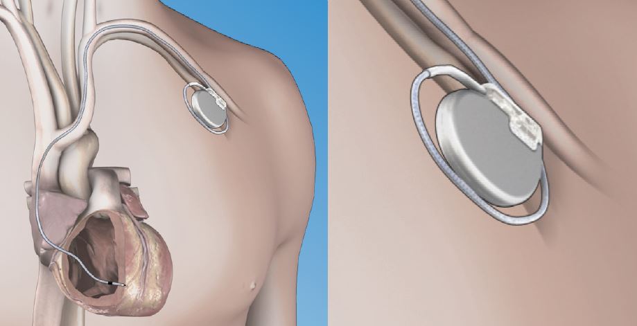 tRADITIONAL PACEMAKER IMPLANT