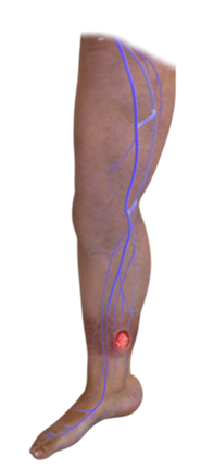 Veins Compression Stockings, Heal Skin Ulcers Varicose Veins